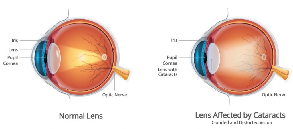 Cataracts Cataracts