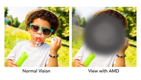 Normal Visions vs View with AMD Normal Visions vs View with AMD